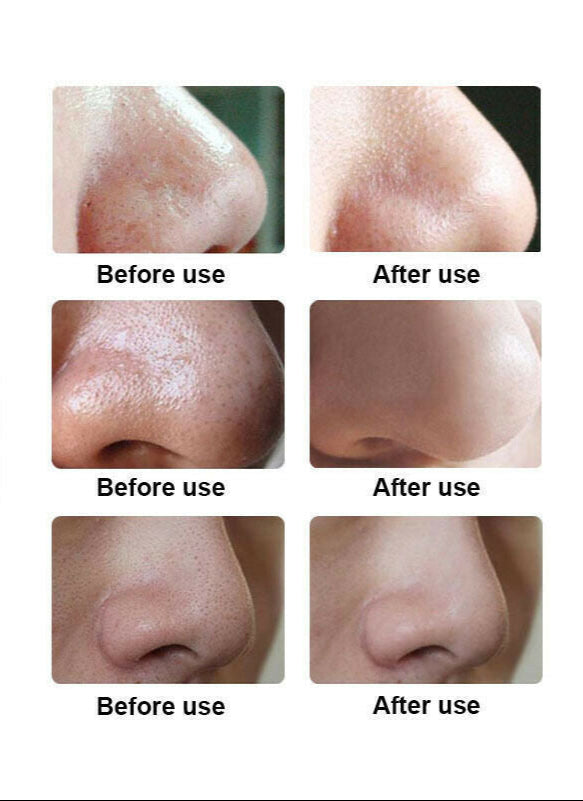 Before and after skincare results using GlowVac™ Deep Pore Cleansing Blackhead Vacuum